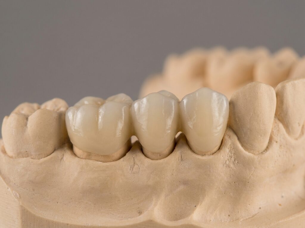 How a Dental Bridge Can Help After Tooth Loss