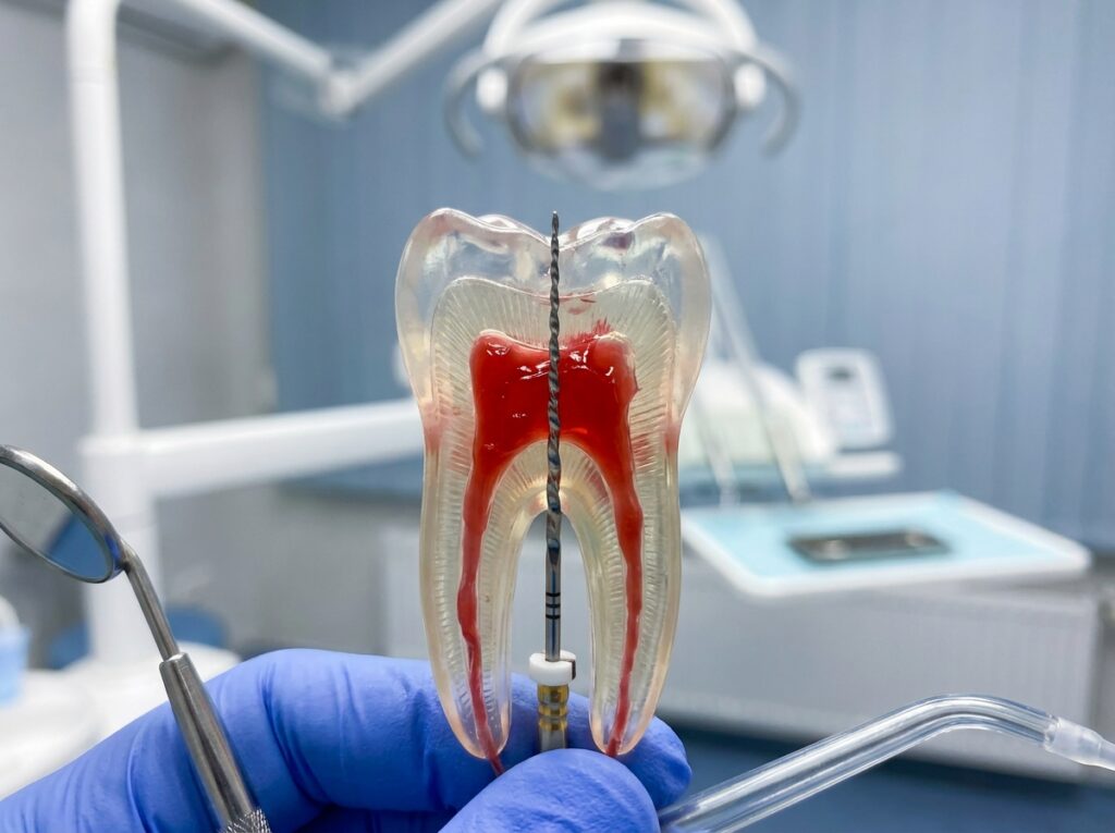 What Is a Root Canal? Do I Need One?